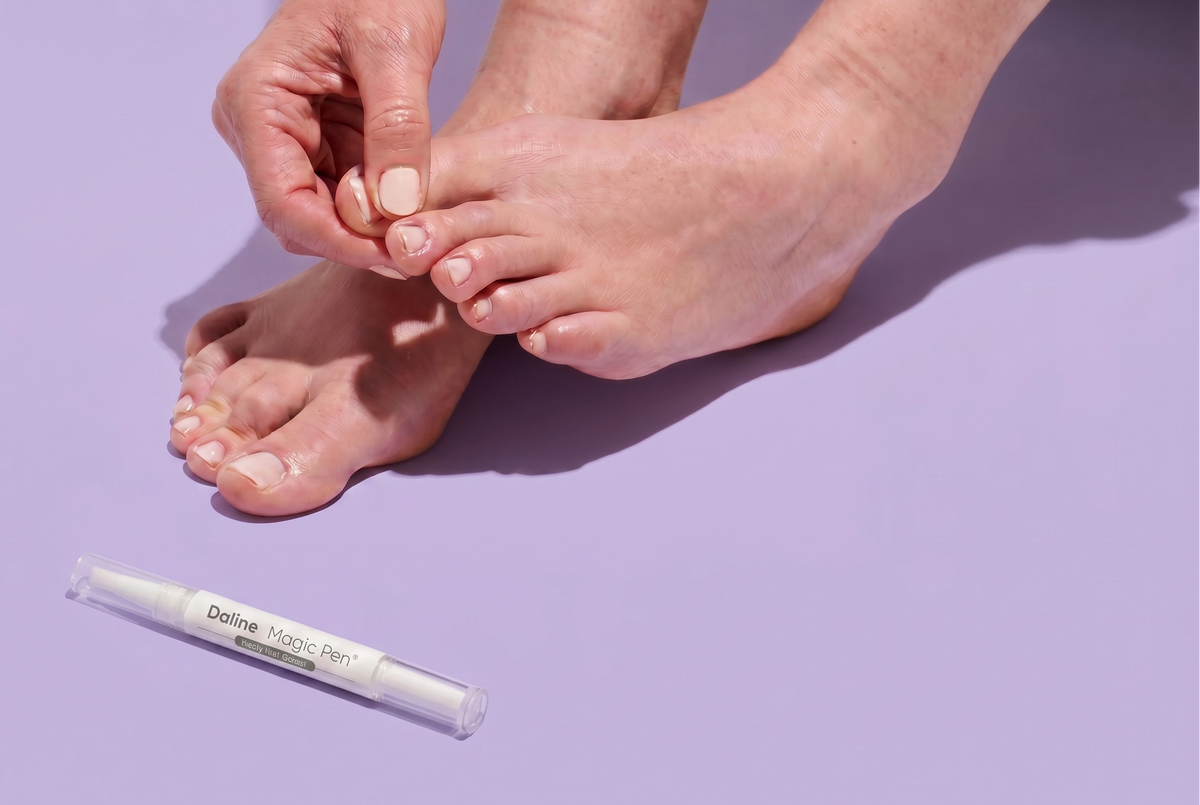 A close-up of a person's hands and feet demonstrating the use of a toe nail product, with a white pen-like applicator labeled 'Daline Magic Pen' placed on a lavender background. nail fungus treatment.