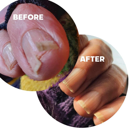 Before and after comparison of a damaged, splitting nail that's grown healthy and smooth.